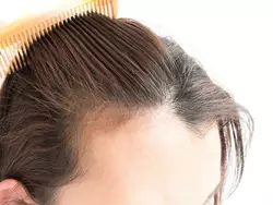 Cosa significa questo per chi soffre di caduta dei capelli