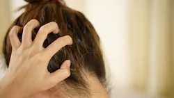 Il ketoconazolo è un trattamento per la caduta dei capelli